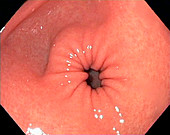 Gastric fundus, endoscope view