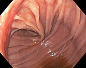 Small intestine, endoscope view