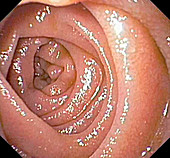 Small intestine, endoscope view