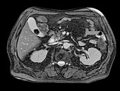 Gallstone, MRI scan