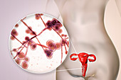 Candida albicans infection in female, illustration