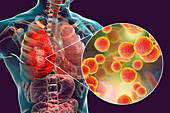 Pneumonia caused by bacteria Mycoplasma pneumoniae, illustra