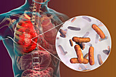Pneumonia caused by bacteria Pseudomonas aeruginosa, illustr