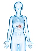 Illustration of adrenal gland cancer