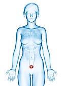 Illustration of bladder cancer