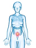 Illustration of colon cancer