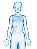 Illustration of gallbladder cancer