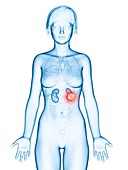 Illustration of kidneys cancer