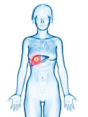 Illustration of liver cancer