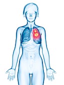 Illustration of lung cancer