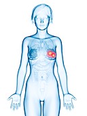 Illustration of mammary glands cancer
