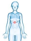 Illustration of pancreas cancer