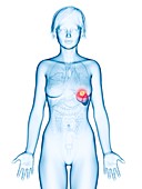 Illustration of spleen cancer