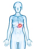 Illustration of stomach cancer