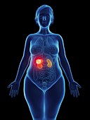 Illustration of a tumour in a woman's kidney