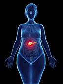Illustration of a tumour in a woman's pancreas