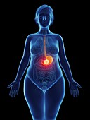 Illustration of a tumour in a woman's stomach