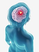 Illustration of a tumour in a woman's brain
