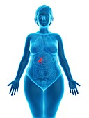 Illustration of an obese woman's gallbladder