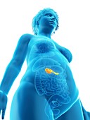 Illustration of an obese woman's pancreas