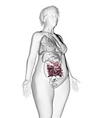 Illustration of an obese woman's small intestine