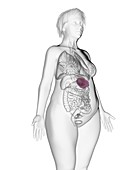 Illustration of an obese woman's spleen