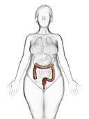 Illustration of an obese woman's colon