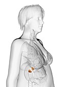 Illustration of an obese woman's adrenal glands