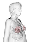 Illustration of an obese woman's mammary glands