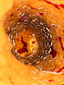 Illustration of a stent inside of an artery