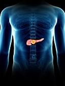 Illustration of a man's pancreas tumour