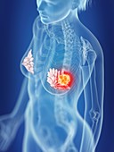 Illustration of a woman's mammary glands cancer