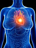 Illustration of a woman's inflamed heart