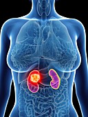 Illustration of a woman's kidneys cancer