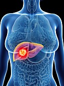 Illustration of a woman's liver cancer