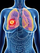 Illustration of a woman's lung cancer