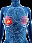 Illustration of a woman's mammary glands cancer