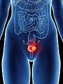 Illustration of a woman's bladder cancer