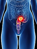 Illustration of a woman's rectum cancer