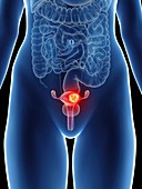 Illustration of a woman's uterus cancer