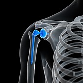Illustration of a shoulder replacement