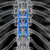 Illustration of a spinal fusion