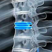 Illustration of a disc replacement