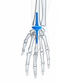 Illustration of a wrist replacement