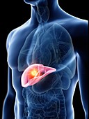 Illustration of a man's liver tumour