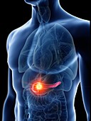 Illustration of a man's pancreas tumour