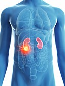 Illustration of a man's kidney cancer
