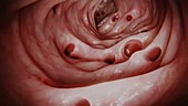 Diverticulosis in large intestine, animation