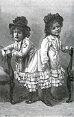 Rosa and Josefa Blazek, Conjoined Twins