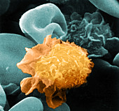 Hairy Cell Leukaemia, SEM